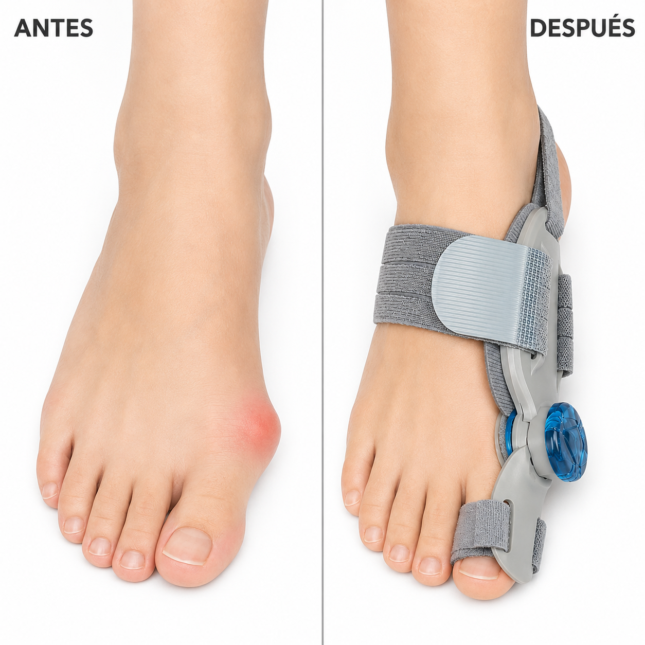 Corrector de juanetes con ajuste graduable | PodoRelief